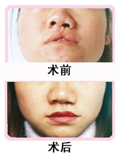 唇裂修复 让你美唇宛若天成