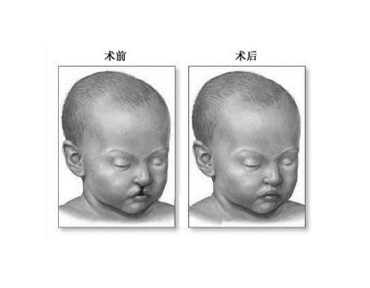揭秘唇裂的原因