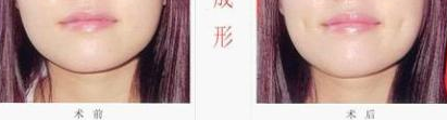 酒窝成形术 给您亲切笑容