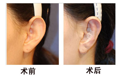 招风耳矫正术后如何护理