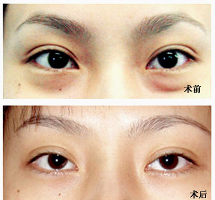眼袋切除手术，让你从此告别眼袋
