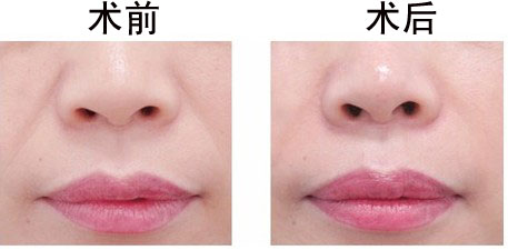 漂唇术后如何护理？