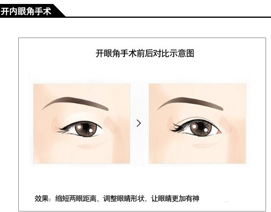 开眼角前后对比