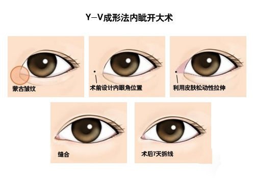     开眼角术让眼睛变大,开眼角方法介绍