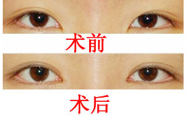     修复双眼皮手术方法，哪种适合您