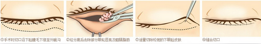 祛眼袋疑问解析
