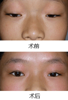 上睑下垂手术有危害吗？