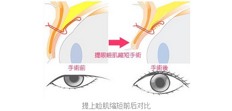 上睑下垂经典案例分析