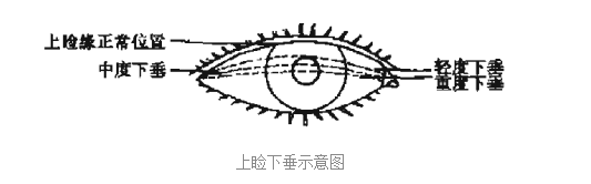 睁眼无力是怎么回事