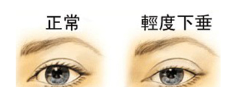 双眼皮下垂怎么办