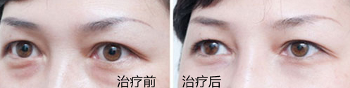 黑眼圈该怎么去除?
