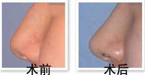 隆鼻的危害有哪些