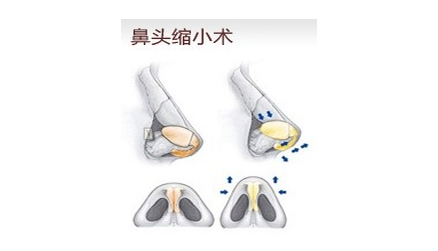 华美鼻头缩小术 塑造精致之美