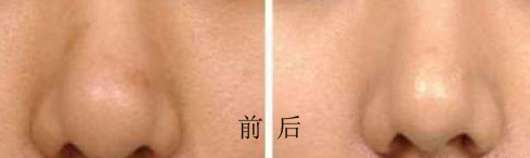 鼻头缩小术后会反弹吗?