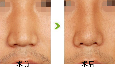 宽鼻该怎么办