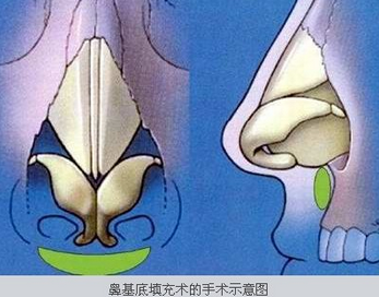 鼻基底填充的手术过程是怎样的?