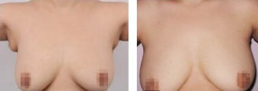 副乳矫正手术难度大吗